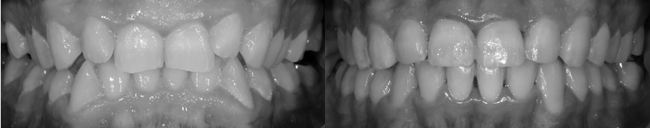imagen antes y después del tratamiento de ortodoncia Insignia de nuestra clínica dental Los Valles en Guadalajara. 