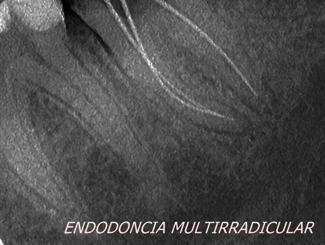 La endodoncia rotatoria nos facilita la obturación o sellado de los conductos. Y, gracias a su desarrollo, con la aparición de materiales estéticos muy resistentes como coronas o fundas.