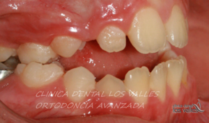 Imagen antes de un caso clínico de nuestra clínica dental en Guadalajara tratado con ortodoncia interceptiva y correctiva. 