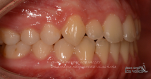 Imagen después de un caso clínico de nuestra clínica dental en Guadalajara tratado con ortodoncia interceptiva y correctiva. 