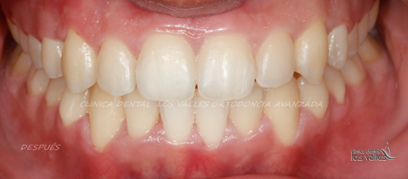 La solución fue tratar con Brackets Damon trasparentes de autoligado. Con este tratamiento, el apiñamiento dental debía parar la rapidez y la capacidad de expansión de su problema origen.