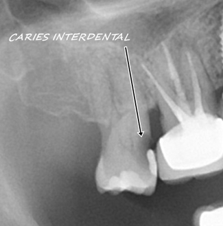 Caso clínico de caries interdental de nuestra clínica dental en Guadalajara: son caries que sólo se muestran en las revisiones con tu dentista ya que, a simple vista, no se ven. Y afectan el espacio interproximal, es decir, aquella entre dos dientes.