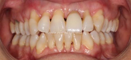 Eliminacion De Los Triangulos Negros Que Afean La Sonrisa Caso De Exito Con Invisalign Clinica Dental Los Valles