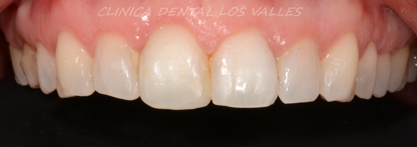 Invisalign para tratar rotaciones y apinamiento