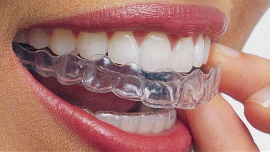 Caso clínico tratado con ortodoncia Invisalign para tratar el apiñamiento dental y la mordida cruzada lateral, por nuestros expertos en ortodoncia, la Dra. María Hernández, de Clínica Dental Los Valles de Guadalajara.