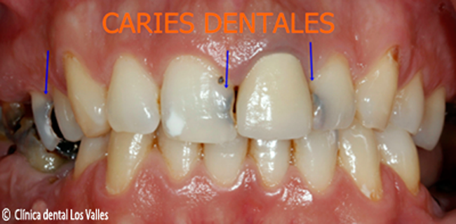 Las caries es el punto de comienzo del diente podrido por dentro. Ahí es cuando aparece el dolor, halitosis, la sensibilidad dental con el frío y el calor y al morder alimentos. Otros síntomas son unos hoyuelos externos negros o de color blanco. Y las infecciones, que terminan en enrojecimiento, pus o la rotura de tu diente.