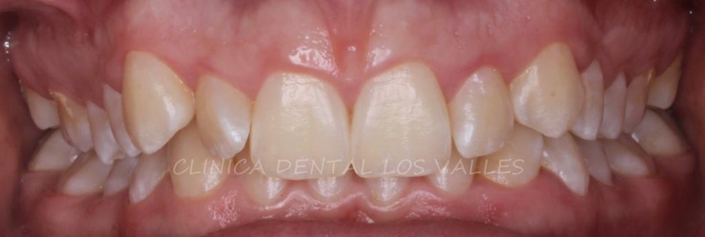 Caso cínico antes del tratamiento de ortodoncia para tratar la sobremordida horizontal en Clínica dental Los Valles. 