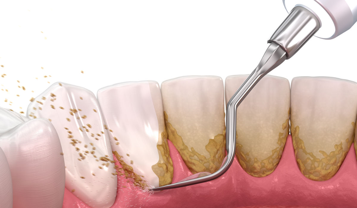 El sarro, conocido como cálculo o tártaro renal, es una película de placa bacteriana calcificada que se acumula en tus dientes. Su tratamiento es sencillo, sólo hay que eliminarlo con una buena limpieza dental o un curetaje, si el cálculo ha profundizado en las bolsas periodontales.