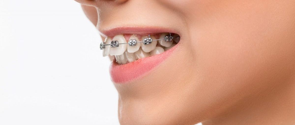 El bracket lingual, Damon (con brackets transparentes) y la ortodoncia invisible son nuestros grandes tratamientos en ortodoncia. ¡Nuestros casos de éxitos nos avalan! En tu primera consulta gratuita podrás conocer qué puedo comer con los brackets.