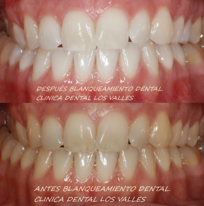 Tu salud oral está relacionada con tu salud general. Porque diferentes estudios afirman que las enfermedades cardiovasculares, neurocognitivas o cancerígenas van de la mano de tu salud bucodental. El esmalte de tus dientes es la sustancia más dura de tu cuerpo y que, junto a la dentina, conforman las distintas capas de un diente. Si notas que su tonalidad cambia o se oscurece con manchas oscuras, amarillentas o grises, debes estar atento. Podríamos hablar de una decoloración dental, caries o incluso una infección dental.