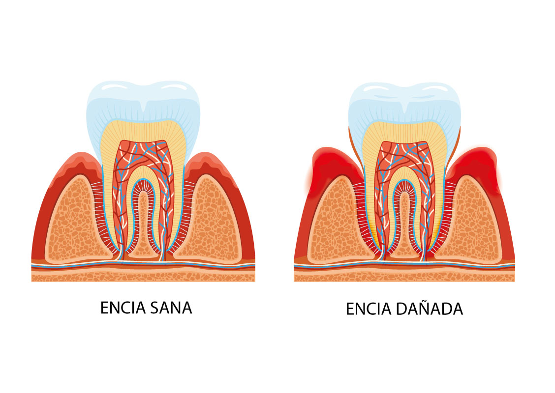 Conocer las causas de las encías retraídas es clave para cuidar de nuestra salud dental. También es importante saber detectar si sufrimos de esta enfermedad de las encías y te explicamos cómo en este post.