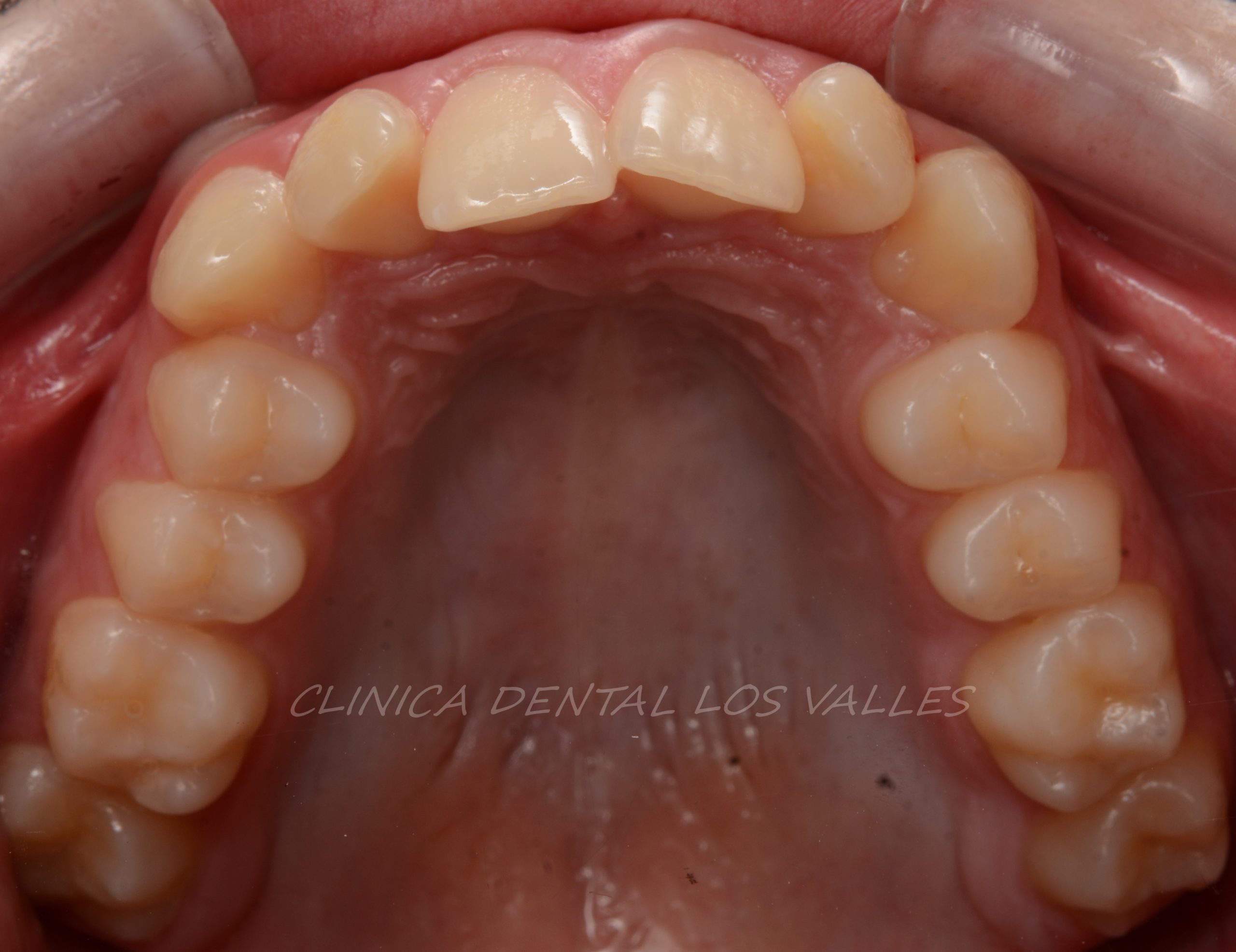 Imagen de un caso clínico antes de ser tratado de ortodoncia con sobremordida con brackets metálicos. 