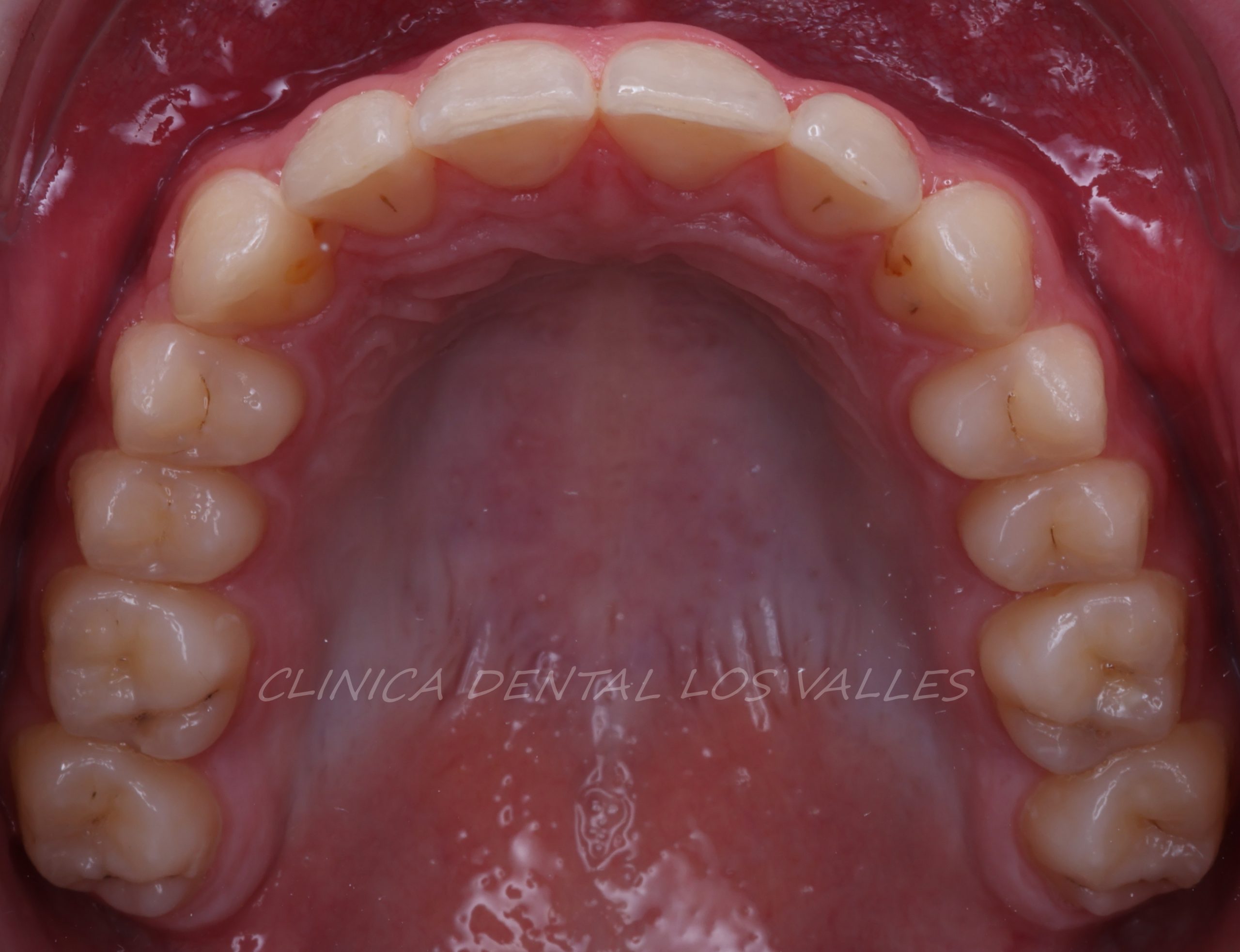 Imagen de un caso clínico tratado de ortodoncia con sobremordida. Una vez que se retiran los brackets, colocamos la retención superior e inferior para estabilizar y conservar los resultados a largo plazo. Nuestros objetivos se han cumplido: la sonrisa ha cambiado totalmente y muestra parte de los incisivos inferiores con un engranaje perfecto. ¡Felicidades! El mejor consejo para estos casos es tratar a medio plazo antes de la edad adulta. Si nuestro paciente no se hubiera tratado preventivamente, habría sufrido dolores articulares y dentales.