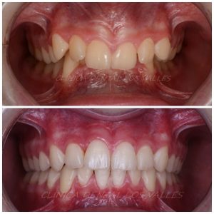 Caso clínico de mordida y paladar de Clínica Dental Los Valles.