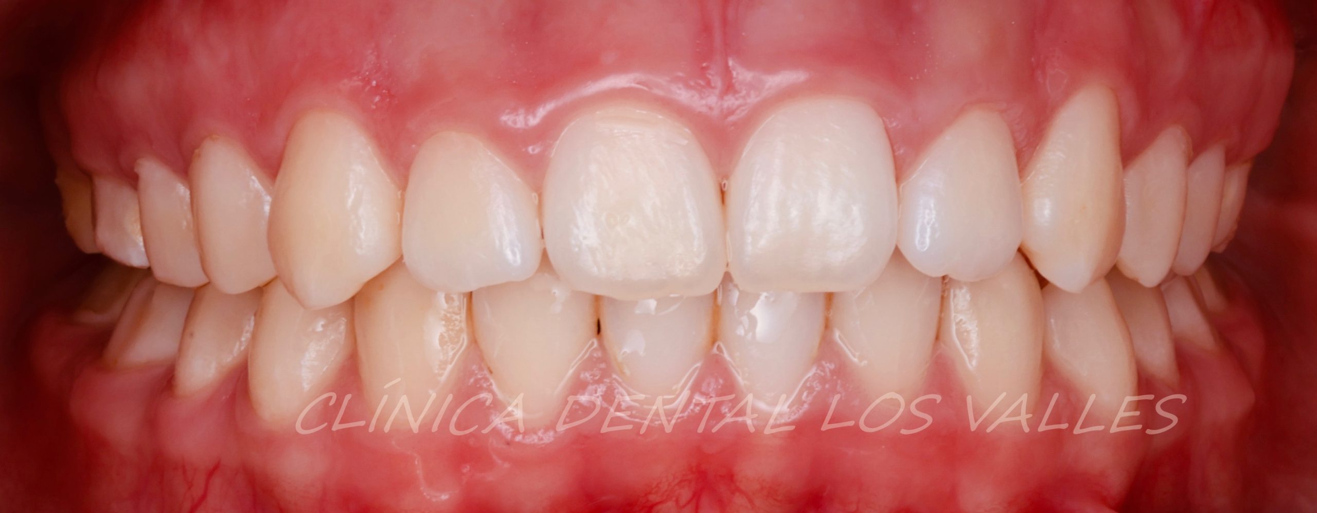 Imagen de nuestra paciente de odontopediatría con disyuntor y brackets en nuestra Clínica Dental Los Valles de Guadalajara. 