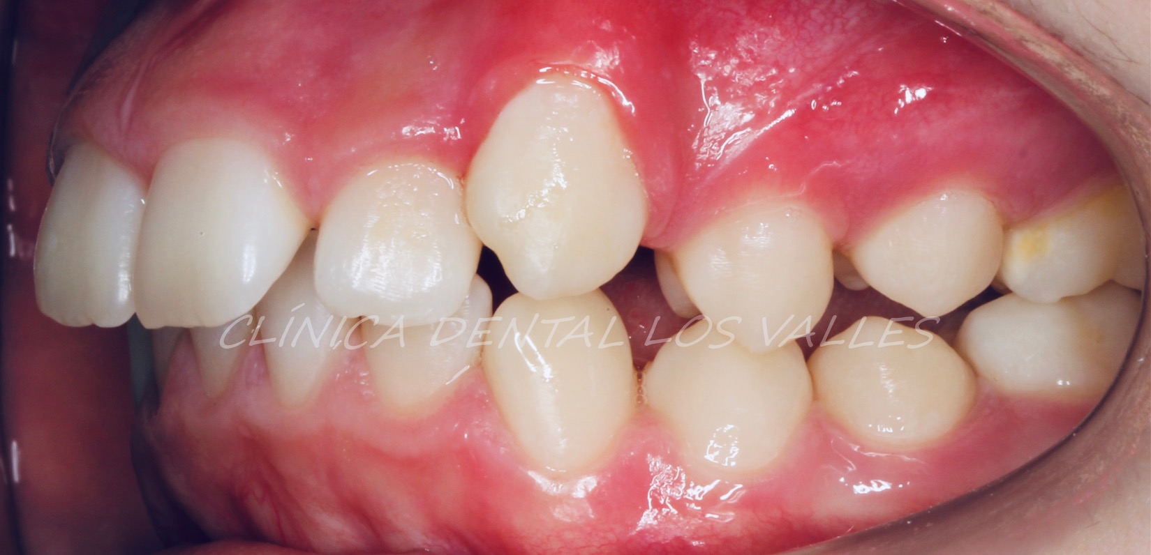 Imagen de nuestra paciente de odontopediatría con disyuntor y brackets antes de ser tratada. Con este procedimiento se consigue corregir la clase 2 molar y canina. Es decir, que la arcada superior y la inferior se engranen perfectamente para conseguir una masticación estable y duradera.