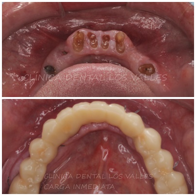 Imagen antes y después de un paciente de Clínica dental Los Valles tratado con un tratamientos de implantes dentales, implantes dentales de carga inmediata. 