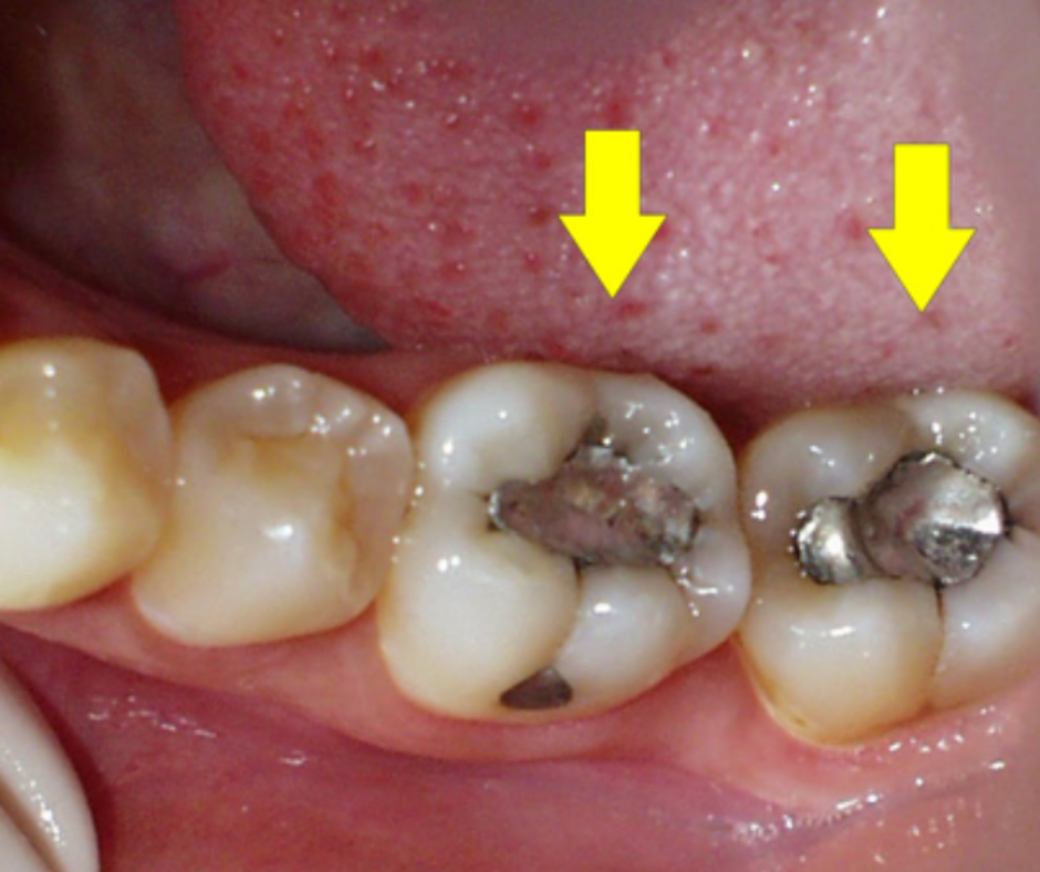 Este nuevo año comienza con cambios en un tratamiento clásico dentro de nuestro sector, el material de los empastes. Aunque su cambio ya se introdujo en nuestra Clínica dental Los Valles hace algún tiempo, hoy queremos hablarte de la importancia de los nuevos materiales aptos de los empastes en nuestros pacientes y de la prohibición del uso de la amalgama de plata en el 2025 por la UE, Unión Europea.