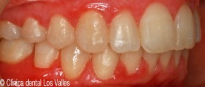 Imagen después del tratamiento con ortodoncia © Clínica dental Los Valles